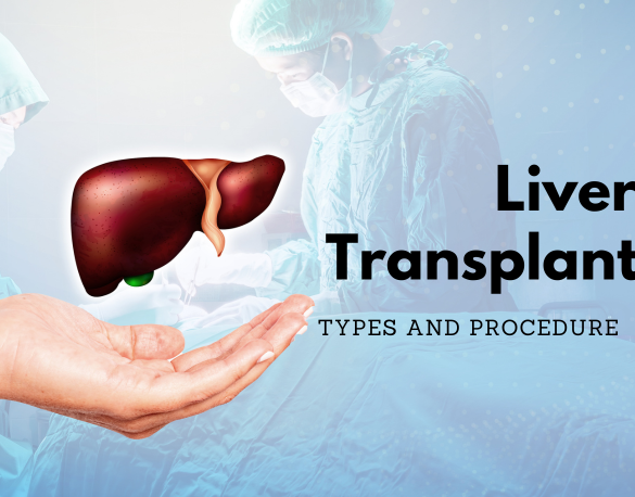 Liver Transplant in Delhi