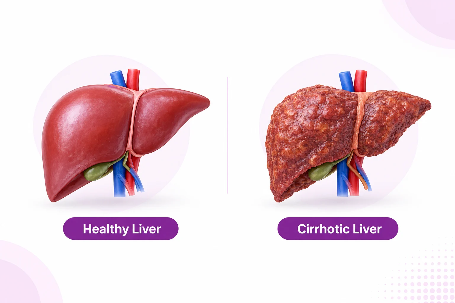 D medical illustration comparing a healthy liver with a cirrhotic liver, showing the difference in smooth and nodular liver texture.