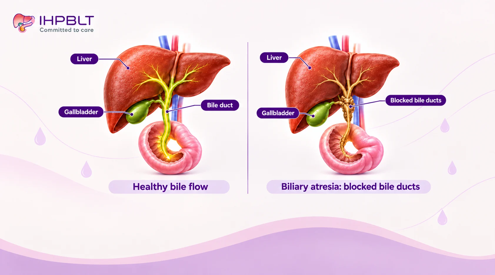 Comparison of a healthy bile duct and biliary atresia in an infant liver, for biliary atresia treatment in Delhi